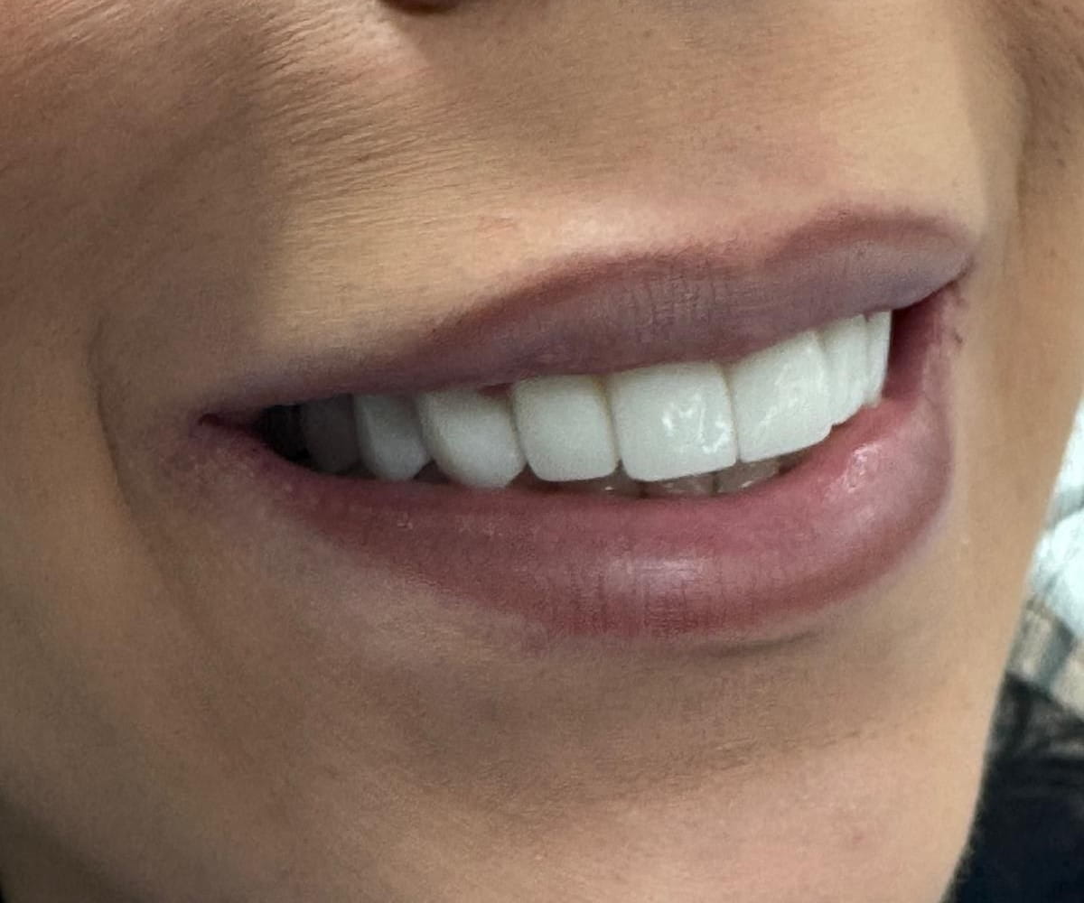Hollywood smile — estetskii rezultat osmeha